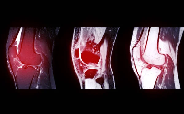 Mri Knee关节或磁共振成像矢状图检测前交叉韧带撕裂或扭伤的比较 Acl — 图库照片