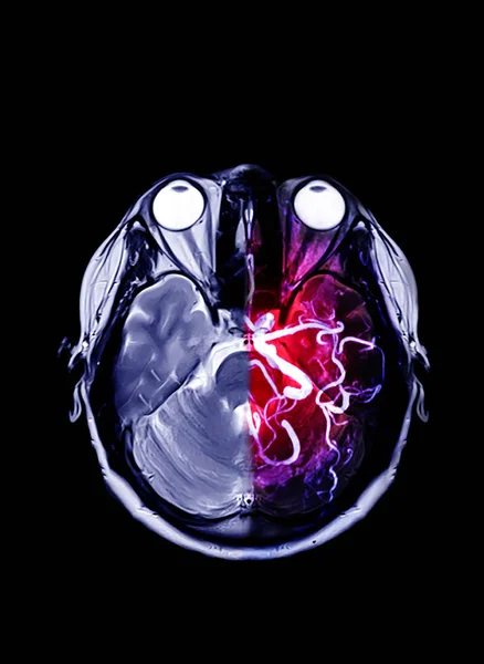 Mri Mra Brain Compare Axial View — Stock Photo, Image