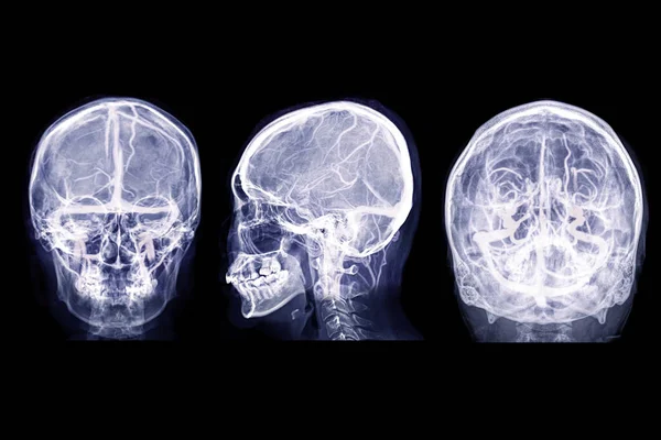 Рентгеновское Изображение Черепа Латеральный Водный Вид Смешивается Mrv Изображение Мозга — стоковое фото
