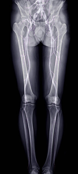 scanogram of lower limb or X-ray image with merge CTA Femoral run off showing bone and vessel of lower limb.