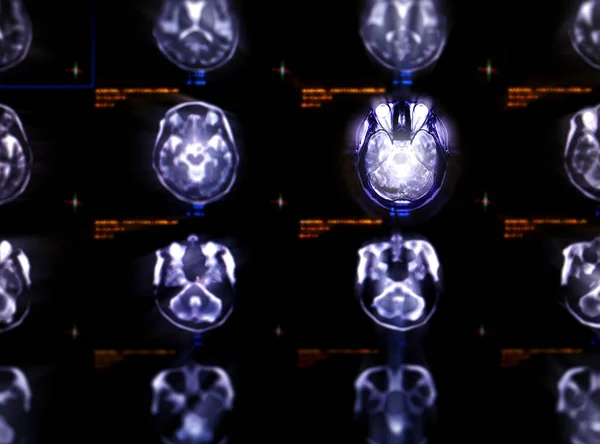 Enfoque Selectivo Visión Axial Del Cerebro Por Resonancia Magnética Para — Foto de Stock