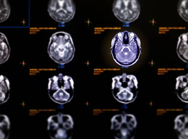 Selective focus of MRI brain axial view for detect a variety of conditions of the brain such as cysts, tumors, bleeding, swelling, developmental and structural abnormalities or infections .