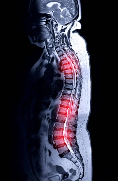 Mri Celé Vyšetření Páteře Pro Diagnózu Komprese Míchy — Stock fotografie