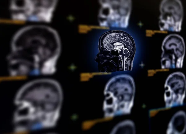 Selektiver Fokus Der Mri Gehirn Sagittalebene Zur Erkennung Einer Vielzahl — Stockfoto