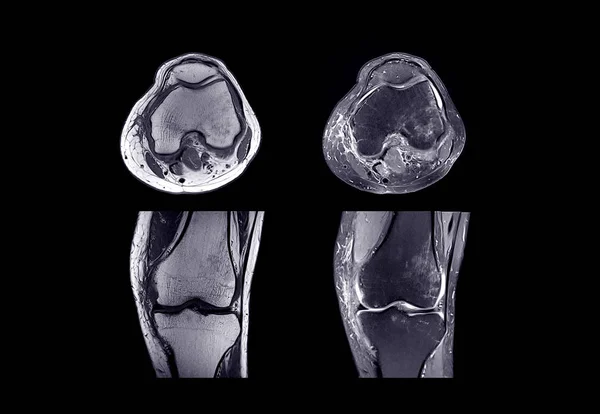 오른쪽 무릎 MRI — 스톡 사진