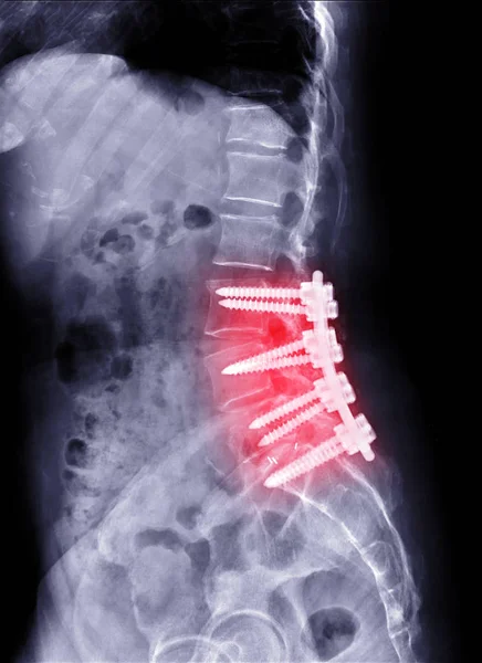 Ray Image Spine Lambosacral Spine Lateral Post Operative Lumbar Fixation — Stock Photo, Image