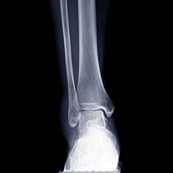 X线踝关节或X线影像或右踝关节X线影像诊断骨折 — 图库照片