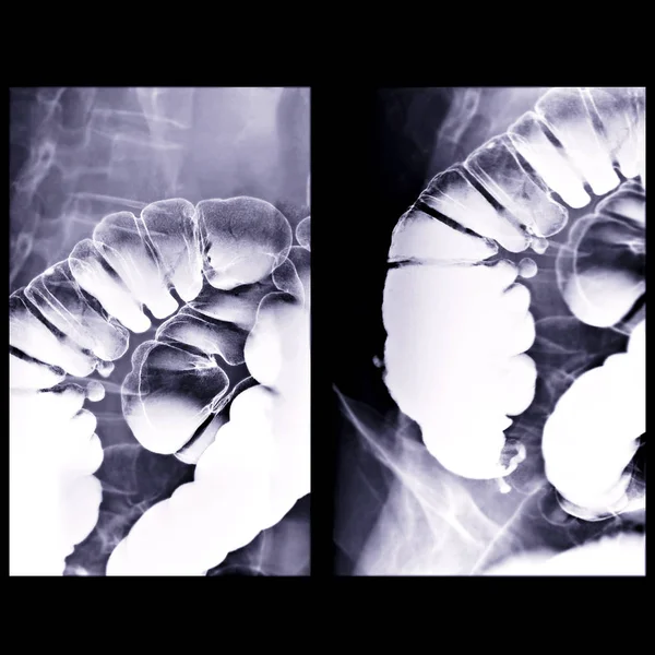 Bárium Beöntés Kép Röntgen Kép Vastagbél Mutatja Emelkedő Fluoroszkópos Ellenőrzés — Stock Fotó
