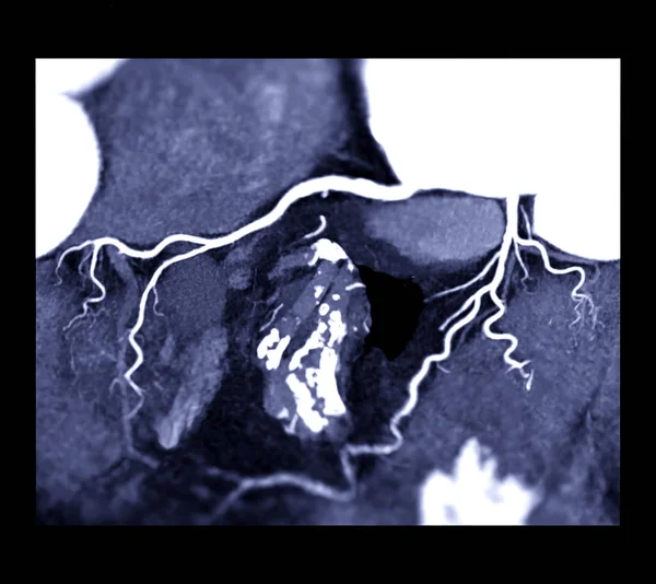 Cta Coronaire Slagader Mip Toont Coronaire Slagader Voor Diagnose Coronaire — Stockfoto