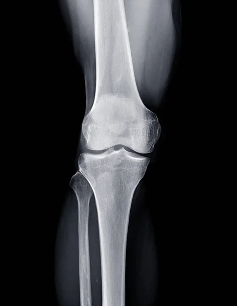 右膝关节Ap视图的X光图像 膝部X — 图库照片