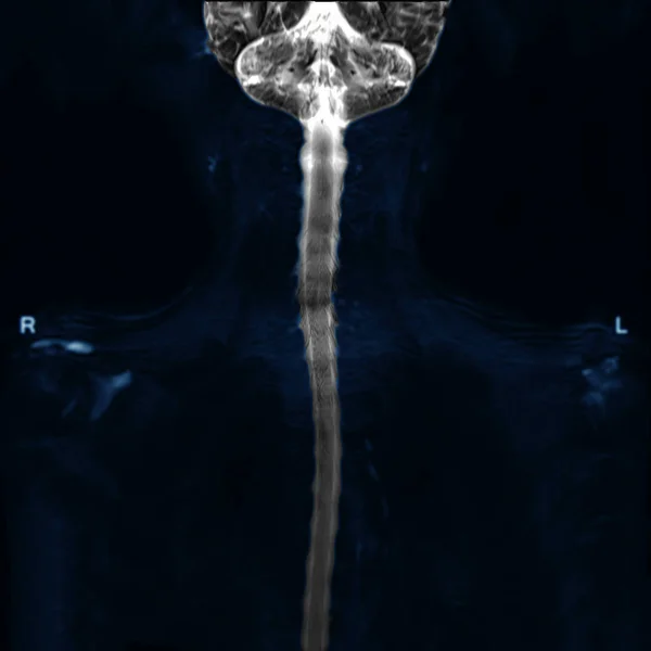 Resonancia Magnética Del Mielograma Técnica Uso Columna Cervical Plano Coronal — Foto de Stock