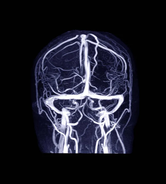 Mrv Hersenen Magnetische Resonantie Venografie Van Het Brein Voor Afwijkingen — Stockfoto