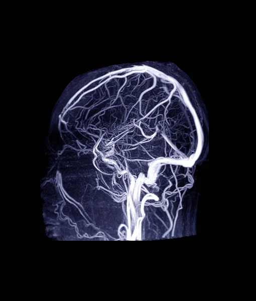 Mrv Hersenen Magnetische Resonantie Venografie Van Het Brein Voor Afwijkingen — Stockfoto