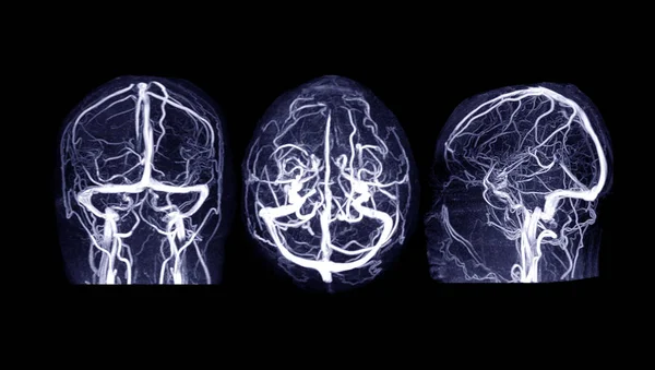 Mrv Venografía Cerebral Por Resonancia Magnética Del Cerebro Para Anomalías —  Fotos de Stock