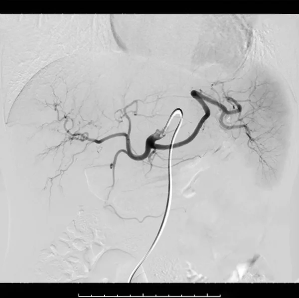 Toce Chemoembolization Een Procedure Die Het Mogelijk Maakt Een Dosis — Stockfoto