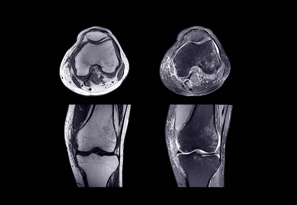 Mri van de rechterknie Stockfoto