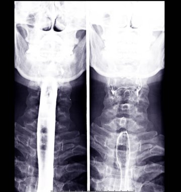 Esophagram ya da Baryum Kırlangıç Görünümü Karşılaştırması Hasta yutulmadan önce ve sonra baryum içeren bir sıvı içer .
