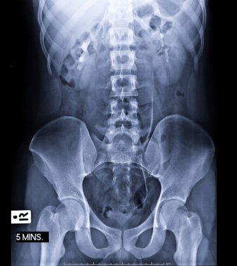 Intravenous piyelogram ya da I.V.P 'nin karşılaştırılması, enjekte edildikten 5 dakika sonra idrar yollarının X-ray muayenesidir.