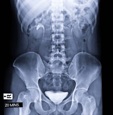  İntravenöz piyelogram ya da I.V.P, 20 dakikalık kontrasttan sonra idrar yollarının X-ray muayenesidir..