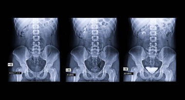 Intravenous piyelogram ya da I.V.P 'nin karşılaştırılması, enjeksiyon kontrast ortam ajanı 0,5,20 dakika sonra idrar yolunun X-ray testidir..