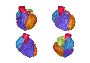 Cta koroner arter 3D görüntüyü koroner arter hastalığını tespit etmek için beyaz arka planda izole ediyor. Kesme yolu.