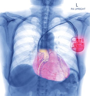 Chest X-ray or X-Ray Image Of Human Chest with pacemaker placement or Cardiac Pacemakers for control heart in patient arrhythmia . check up concept. clipart