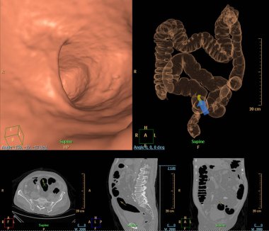 CT colonography compare 2D Axial,sagittal ,coronal plane  and 3D rendering image for screening colorectal cancer. Check up Screening Colon Cancer. clipart