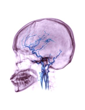  CTA brain or CT angiography of the brain 3D Rendering image fusion with skull lateral view  showing position common carotid artery in the brain. clipart