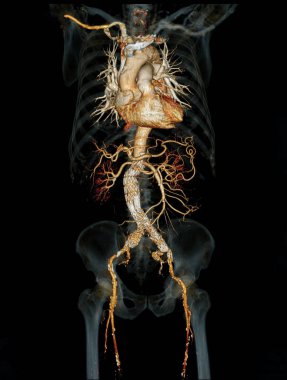 Şeffaf iskelet üzerinde stent grefti ile Cta abdominal aort 3d görüntüleme .