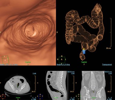 CT colonography compare 2D Axial,sagittal ,coronal plane  and 3D rendering image for screening colorectal cancer. Check up Screening Colon Cancer. clipart