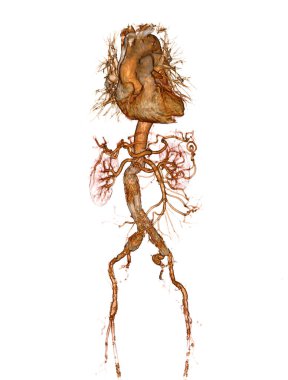 Stent grefti ile Cta abdominal aort 3d görüntüleme .