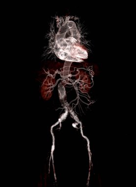 Şeffaf iskelet üzerinde stent grefti ile Cta abdominal aort 3d görüntüleme .