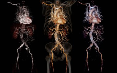 Şeffaf iskelet üzerinde stent grefti ile Cta abdominal aort 3d görüntüleme karşılaştırması .