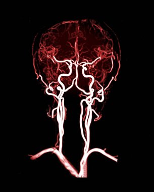  MRA brain Coronal 3D MIP veiw showing Common carotid artery and cerebral artery . clipart