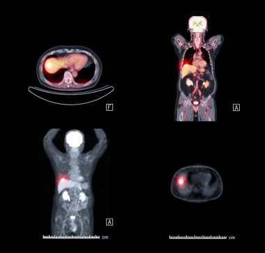 PET CT Scan image of whole body comparison Axial ,Sagittal and  plane for detect cancer recurrence in patient cancer disease . clipart