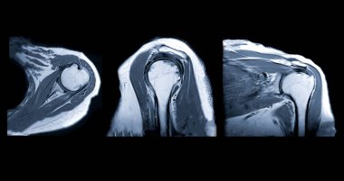 MR Omuz eklem manyetik rezonans görüntüleme (MR) MR, Koronal ve sagittal düzlem teşhis için omuz eklem ağrısı veya tendonlar, kas yaralanması.