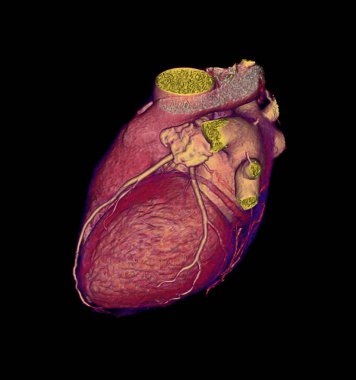 CTA Coronary artery  3D rendering image for finding coronary artery disease. clipart