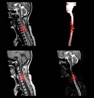 A sagittal view of MRI C-spine or magnetic resonance image of cervical spine showing spondylosis causing cervical spondylotic myelopathy and compression fracture. clipart