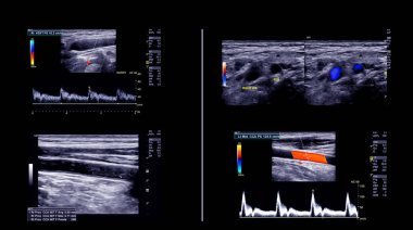 Derin ven trombozunu bulmak için ultrason doppler.
