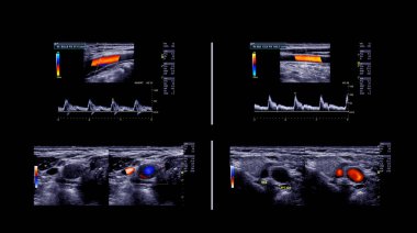 Derin ven trombozunu bulmak için ultrason doppler.