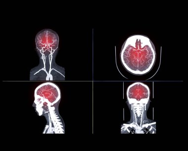  Beynin Cta beyni ya da Ct anjiyografisi Coronal ve Sagittal view füzyon 2d ve 3d görüntüleme karşılaştırması. tıbbi teknoloji kavramı.
