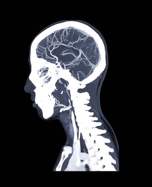  Beyin sagital mip görüntüsünün CT anjiyografisi. tıbbi teknoloji kavramı.