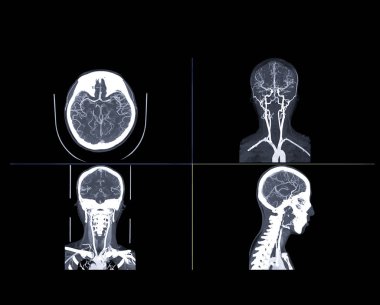  Beynin Cta beyni ya da Ct anjiyografisi Coronal ve Sagittal view füzyon 2d ve 3d görüntüleme karşılaştırması. tıbbi teknoloji kavramı.