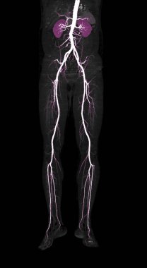 Cta femoral arter akut ya da kronik çevresel arter hastalığı olan hastalar için böbrekle uyluk atardamarının 3 boyutlu görüntüsünü oluşturur..