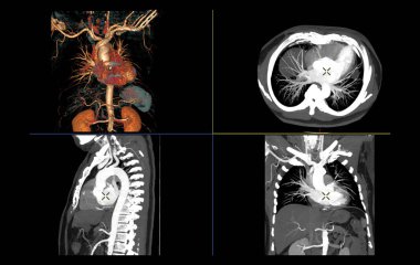 Torasik aort 3d enjeksiyon kontrastlı görüntüyü torasik aort karşılaştırması Axial, Sagittal ve Coronal görünümüne dönüştürme.