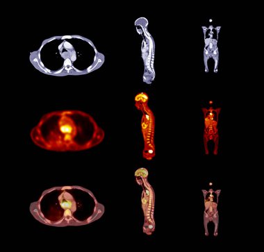 PET CT Scan image of whole body comparison Axial ,Sagittal and  plane for detect cancer recurrence in patient cancer disease . clipart