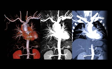 Aort anevrizması teşhisi için torasik aorta enjekte edilen Cta torasik aortunun toplanması.