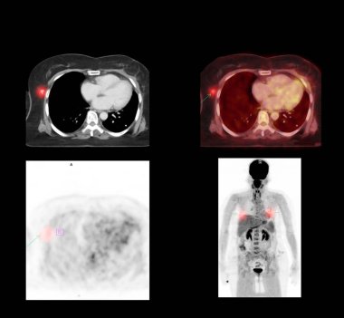 Bilgisayarlı tomografi taramasında tüm vücut karşılaştırması Axial düzlemi ve hasta akciğer kanseri hastalığında tekrar eden kanseri tespit etmek için Pet Ct .