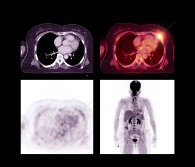 Bilgisayarlı tomografi taramasında tüm vücut karşılaştırması Eksen düzlemi ve ekranda Pet Ct Hasta akciğer kanseri hastalığında kanser nüksetmesini tespit etmek için .