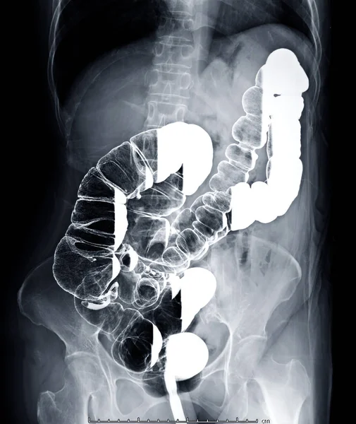 大肠的钡灌肠图像或X射线图像显示结肠解剖以检测结肠癌 收割路径 — 图库照片